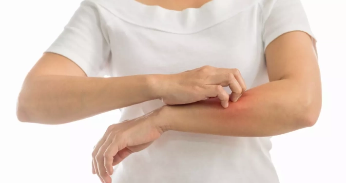 Dalla dermatite all’orticaria: le più comuni allergie da contatto